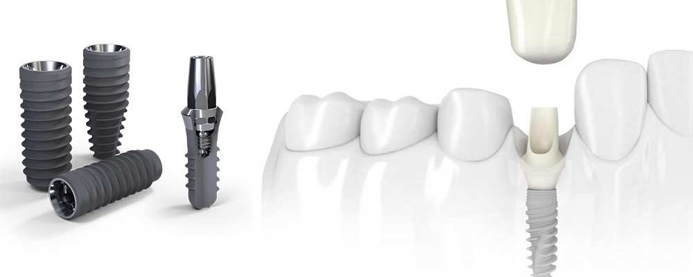 Why Is Teeth Cleaning Recommended by Dental Professionals