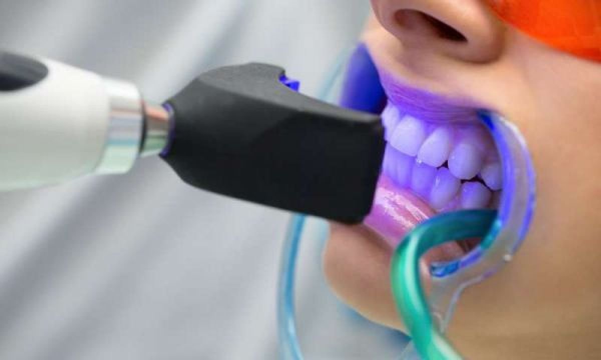 How Professional Teeth Whitening in Seattle Brightens Smiles