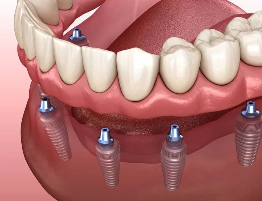 How Dental Implants Provide a Natural Look and Strong Support?
