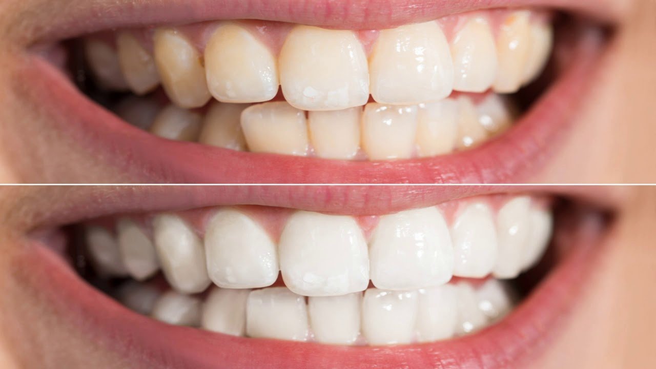 How Does Teeth Whitening Enhances Overall Dental Appearance