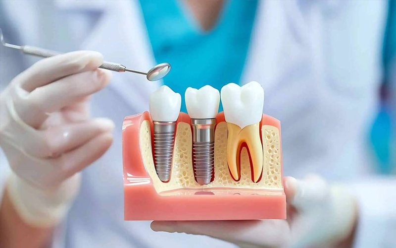 Affordable Dental Implants